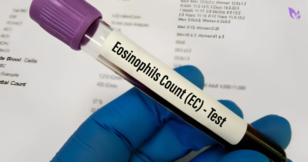 High Eosinophils Parasites